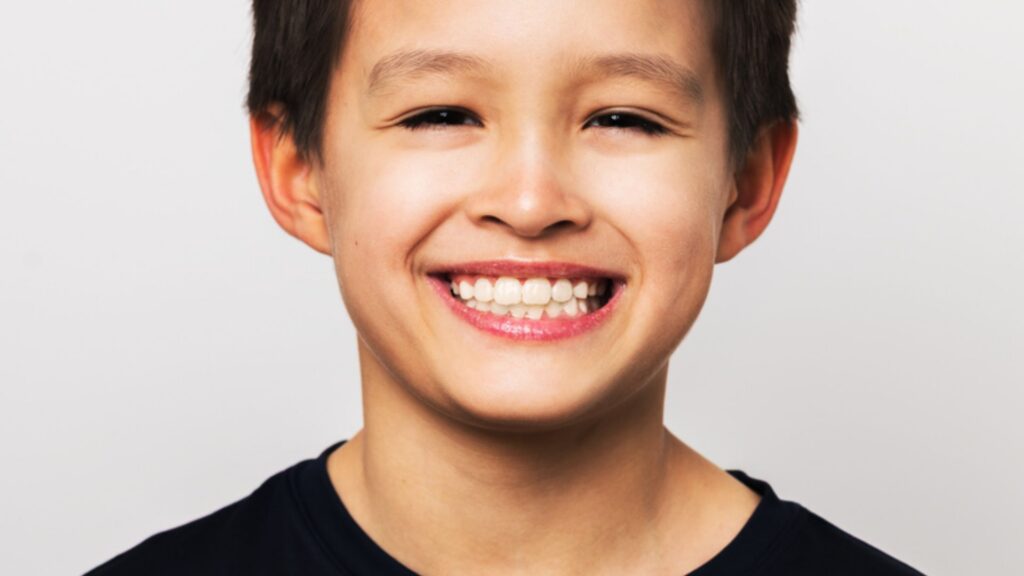 What Is a Regenerative Palatal Expander (RPE)?