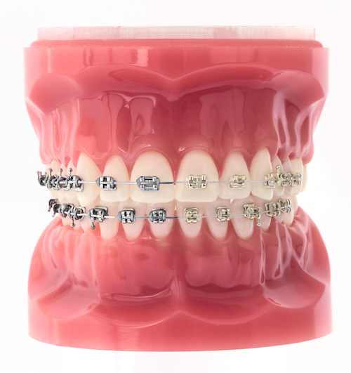Iconix braces model with half metal and half Iconix braces
